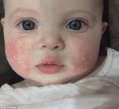 More than 10,000 happy customers. Brisbane Baby With Severe Eczema On Her Face Told She Ll Have To Wait A Year For Treatment Daily Mail Online