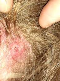 Naturally curly or coarse hair Infected Ingrown Hair That Left A Hole In The Side 0f My Head Ingrownhairs