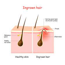 They're different from other bumps because you usually can see the dark hair inside the bump. No More Irritating Ingrown Hair S With Laser Hair Removal