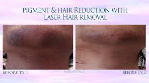 A revolution is underway, for body hair removal that is virtually painless. Laser Hair Removal Toronto Laser Essential Skin Care