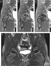 Hip strain hip and pelvis diagram hip bone hamstr anatomy of the sacrum sacrum hip joint hip anatomy hamstring muscles pelvic girdle. Normal Hip Joint Fluid Volumes In Healthy Children Of Different Ages Based On Mri Volumetric Quantitative Measurement Springerlink