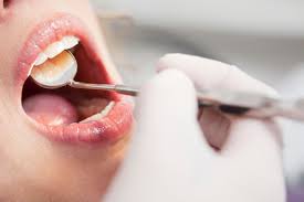 This article covers examination also known as a canker sore, this is a small to medium, round ulcer. Oral Sex And Smoking Fuel 50 Rise In Mouth Cancer But Do You Know The Six Deadly Signs To Watch For