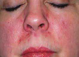 Six-Month Facial Rash Continues To Burn | Clinician Reviews