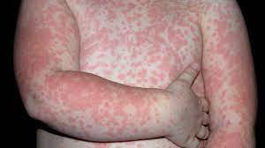 Common Skin Rashes Everyday Health