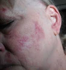 Chronic Cutaneous Lupus Erythematosus And Topical Clindamycin Bmj Case Reports