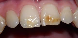 Faq What Are Hypocalcified Teeth Discovery Pediatric Dentistry