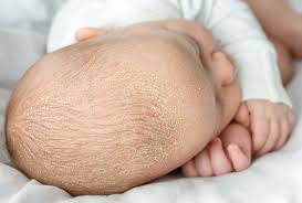 Image result for Cradle Cap