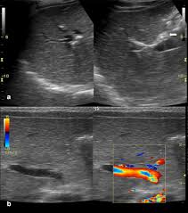 It is one of the most common causes of neonatal. Ultrasound Findings In Paediatric Cholestasis How To Image The Patient And What To Look For Abstract Europe Pmc