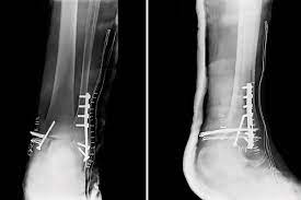 Cuanto Paga La Art Por Fractura De Tibia O Perone Marin Pistachia