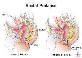 Rectal Prolapse: Symptoms, Causes & Treatment