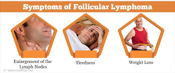 These are most commonly in the neck, armpits and groin area. Follicular Lymphoma Causes Symptoms Diagnosis Treatment And Prevention