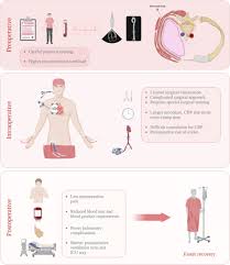 Image result for Intrapleural Anesthesia