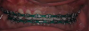 10 mm gummy smile decreased by orthodontic. Gummy Smile After Braces Your Gum Doctor In Delaware Can Fix It Southern Delaware Dental Specialists