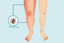 Lyme Arthritis Symptoms And Treatment