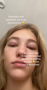 Swollen Eye from Mono