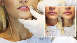 Before and after 1/2 syringe of juvederm volbella in lips, and 1 syringe restylane defyne in nasolabial folds. Lip Filler Experience Start To Finish With 1 Syringe Of Juvederm Youtube