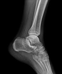 Image result for Calcaneus Compression Fracture