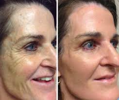 الفرق بين ابر النضاره و البلازما للوجه بشرة وشعر Instantly Ageless Ageless Best Face Products