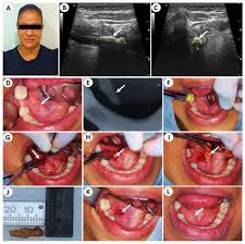 Image result for Submandibular Exam