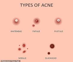 It also looks at different kinds of pimples, their causes, and how to prevent them. The Six Types Of Pimple And How To Deal With Each One Daily Mail Online