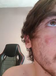 A large or growing hard lump under your armpit can be a serious sign that should never be ignored. Hard Lump Under Skin Was Pretty Painful To Touch But Not So Much Anymore Feels Like It S Full Of Puss I M 23 Dermatology