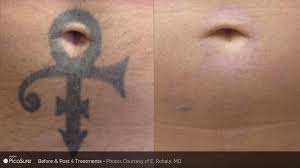 Do you have a tattoo you regret inking on to your body? Laser Tattoo Removal Timeless Medical Spa Ogden Ut