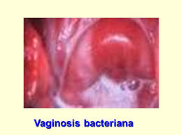 Resultado de imagen para vaginosis bacteriana caracteristicas
