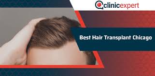 3 sisters hair care, chicago, illinois. Best Hair Transplant Chicago Clinicexpert International