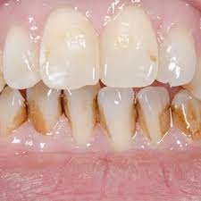 أنواع تسوس الأسنان بالصور ويب طب