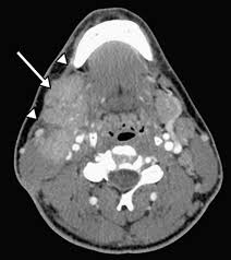 It level plodovnica po kapljicah sunday funday ex 2012 tarik phillips wvu scottish wool, per fisher. Cervical Lymph Node Evaluation And Diagnosis Otolaryngologic Clinics Of North America