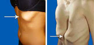 Splenic trauma is physical injury to the spleen, the lymphatic organ located in the upper left side of the abdomen just under the rib cage. 10 Proven Ways To Fix Flared Ribs Without Surgery In 2020 More