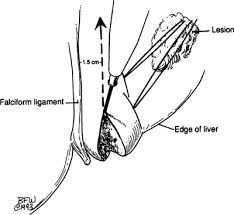 Blood flows through the liver sinusoids and empties into the central vein of each lobule. Liver Springerlink