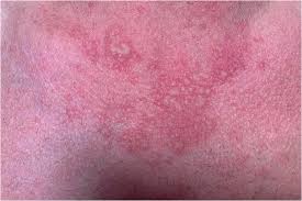 Image result for Polymorphous Light Eruption