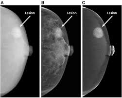 Image result for Mammogram Interpretation