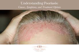Image result for psoriasis