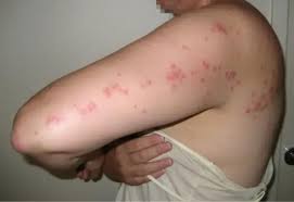 Image result for bedbugs bites