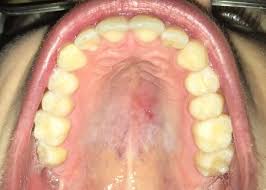 Image result for oral herpes symptoms roof of the mouth