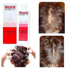 If you have questions about side effects, call your doctor. Nizoral Hair Loss All Products Are Discounted Cheaper Than Retail Price Free Delivery Returns Off 61