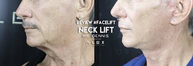 Neck Lift