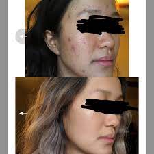 Usually this state of hairloss is temporary and the hair will grow back over time. After 1 Year Of Being On Spironolactone Acne