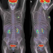 A ct scan can't determine whether that will happen, says dr. Pet Ct Scan Of A Patient With Breast Cancer A Trace Amount Of Download Scientific Diagram