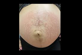 Image result for pruritic urticarial papules and plaques of pregnancy