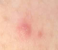 If you do experience acne or ingrown hairs after shaving your butt, he recommends using a cleanser with salicylic acid. Pretty Sure This Is An Ingrown Hair But Anxiety Is Through The Roof Atm Other Conditions And General Health Forums Patient