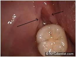 What are home remedies for sore gums? Dr Jeffrey Dorfman Dentist