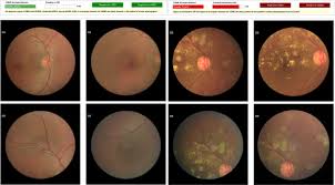 Performance statistics of the benchmark and our approaches on test dataset. Fundus Photograph Based Deep Learning Algorithms In Detecting Diabetic Retinopathy Eye