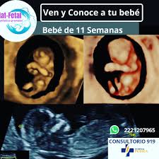 Matfetal Puebla On Twitter Ultrasonido Genetico 11 14 Semanas Sirve Para La Deteccion De Sindrome De Down Preeclampsia Restriccion Del Crecimiento Y Parto Prematuro Consultorio 919 Hospital Puebla Citas Al Celular Y Whatsapp
