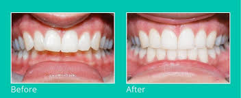 Most cases take 24 months. Perfect Teeth With Dental Aligners Eon Aligner Orthodontic Blog
