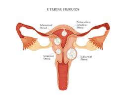 Fibroid adalah jenis tumor yang tumbuh di jaringan fibrosa. Miom Penyebab Gejala Diagnosis Pengobatan