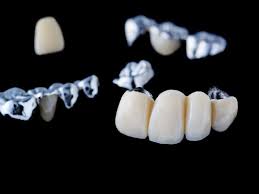 Apr 16, 2020 · how to temporarily recement a crown (or bridge) that has fallen out. Can A Dental Bridge Be Removed And Recemented