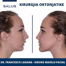 ✓👉Kirurgjia ortonjatike, apo kirurgjia e nofullave është ajo degë e  kirurgjisë maxilla faciale që mundëson korigjimin e një spektrumi të gjerë  deformitetesh apo anomalish skeletike të fytyrës dhe të dhëmbëve. ➡️Është  një